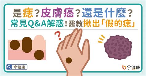 紅色痣代表什麼|是痣？皮膚癌？還是什麼？常見Q&A解惑！醫教揪出「。